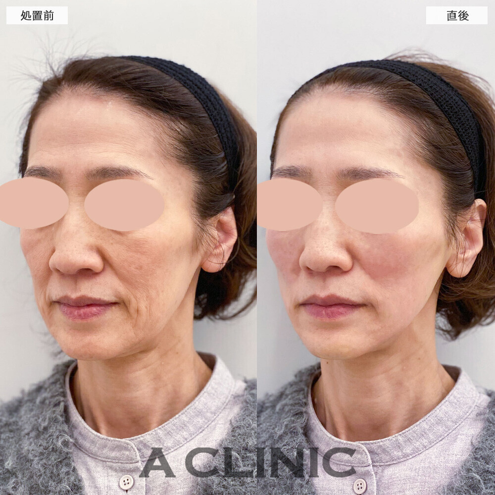 Aスレッドとボトックス注射(しわ)で深いしわも改善！こちら処置前から1ヶ月後の症例です(60代女性)