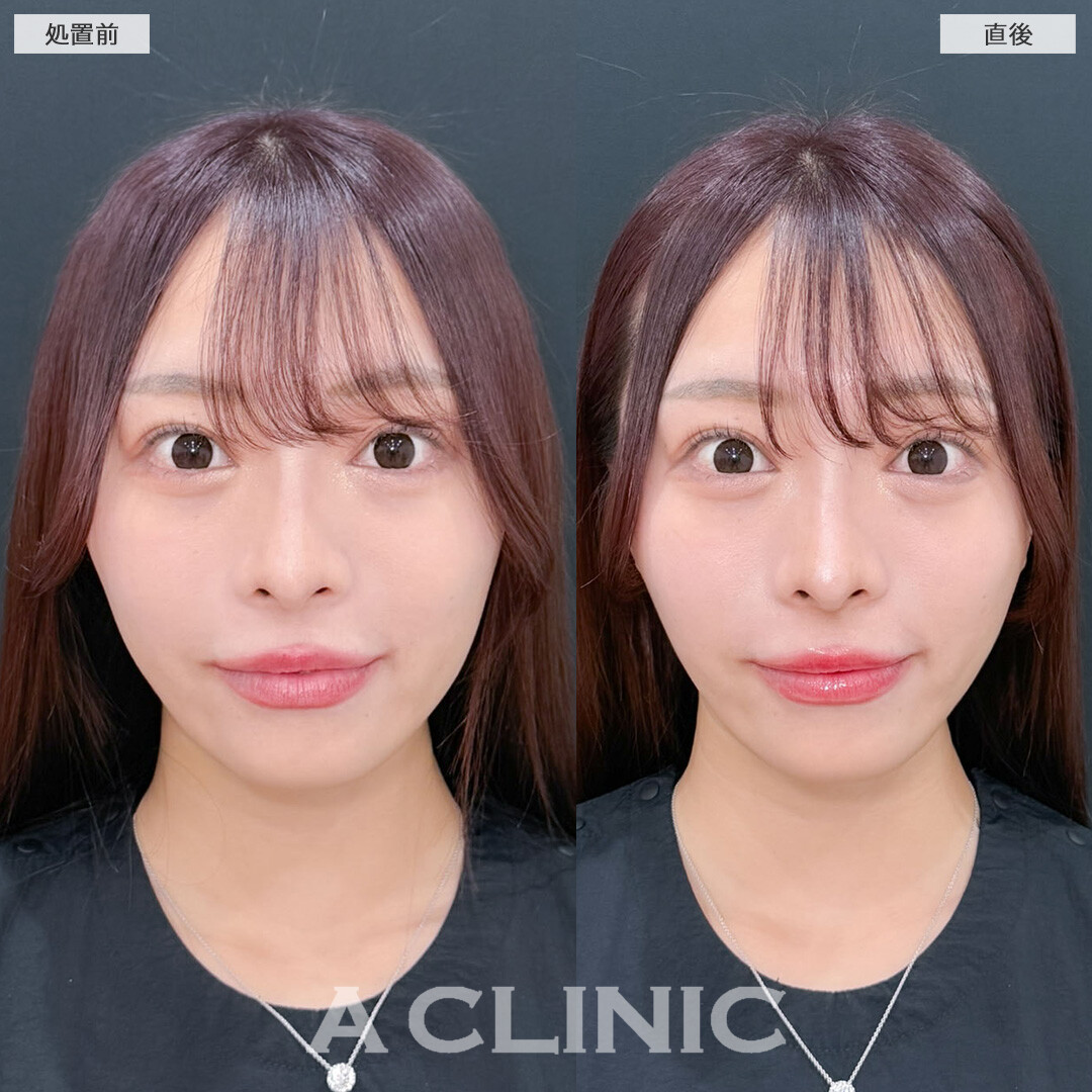 Aスレッドでダウンタイム少なくしっかりフェイスラインを引き上げ！こちら処置前と直後の症例です(20代女性)