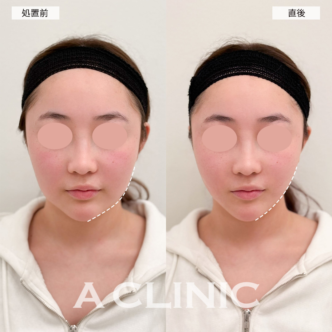 Aスレッドで直後からリフトアップし垢抜け成功!こちら処置前と直後の症例です(10代女性)