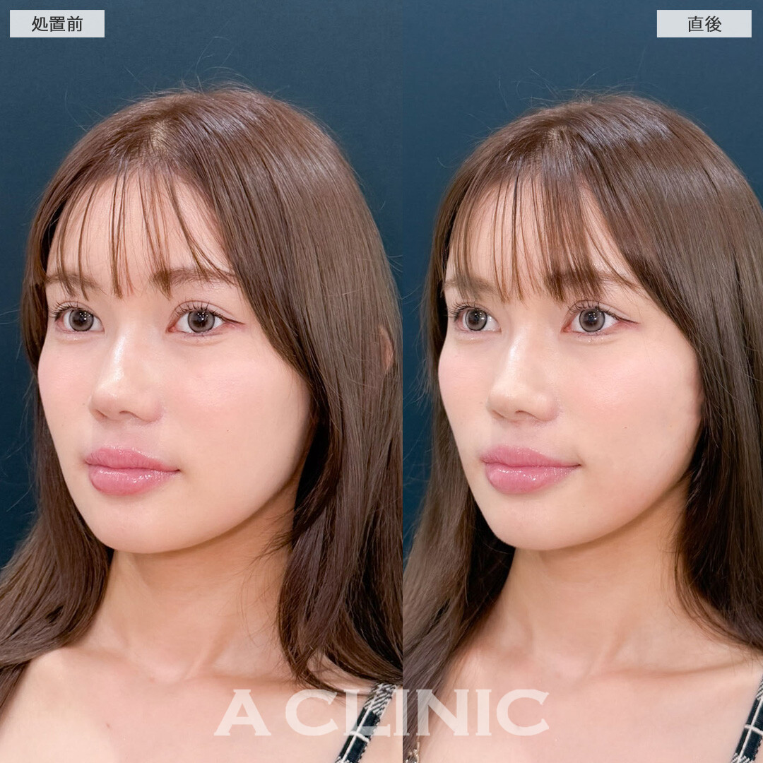 Aスレッドと小顔エラボトックスでもたつきも気にならなくなります！こちら処置前と直後の症例です(20代女性)