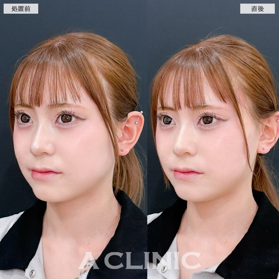 Aスレッドで自然にたまご型フェイスに！こちら処置前と直後の症例です(20代女性)