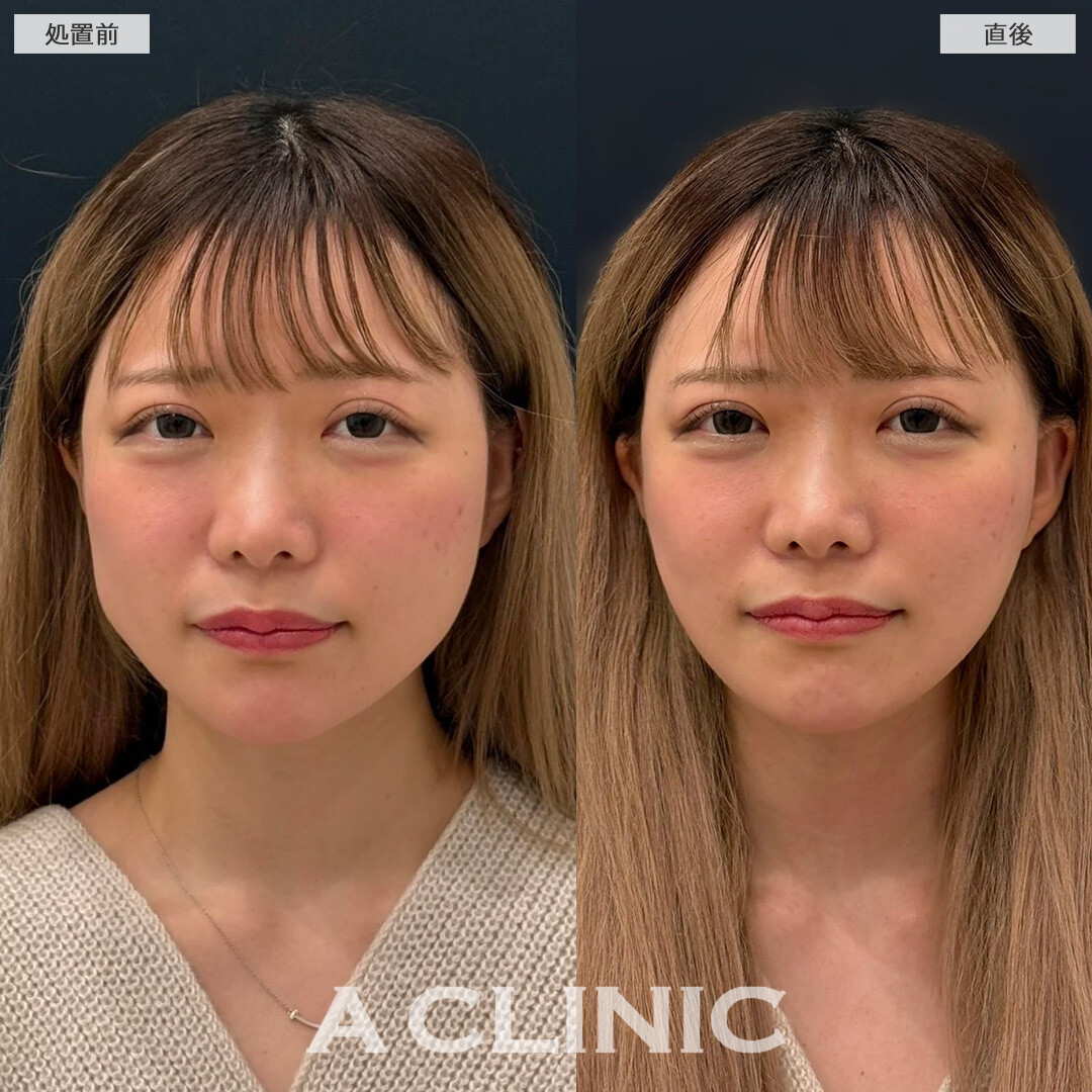 Aスレッドで気になっていたホホのたるみ改善しました！こちら処置前と直後の症例です(20代女性)
