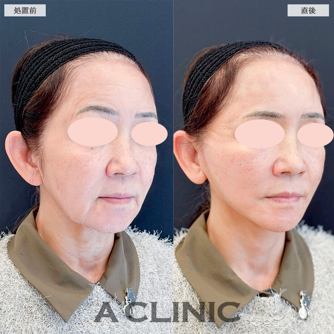 Aスレッドでたるみとマリオネットラインを同時に解消！処置前と直後の症例です(60代女性)