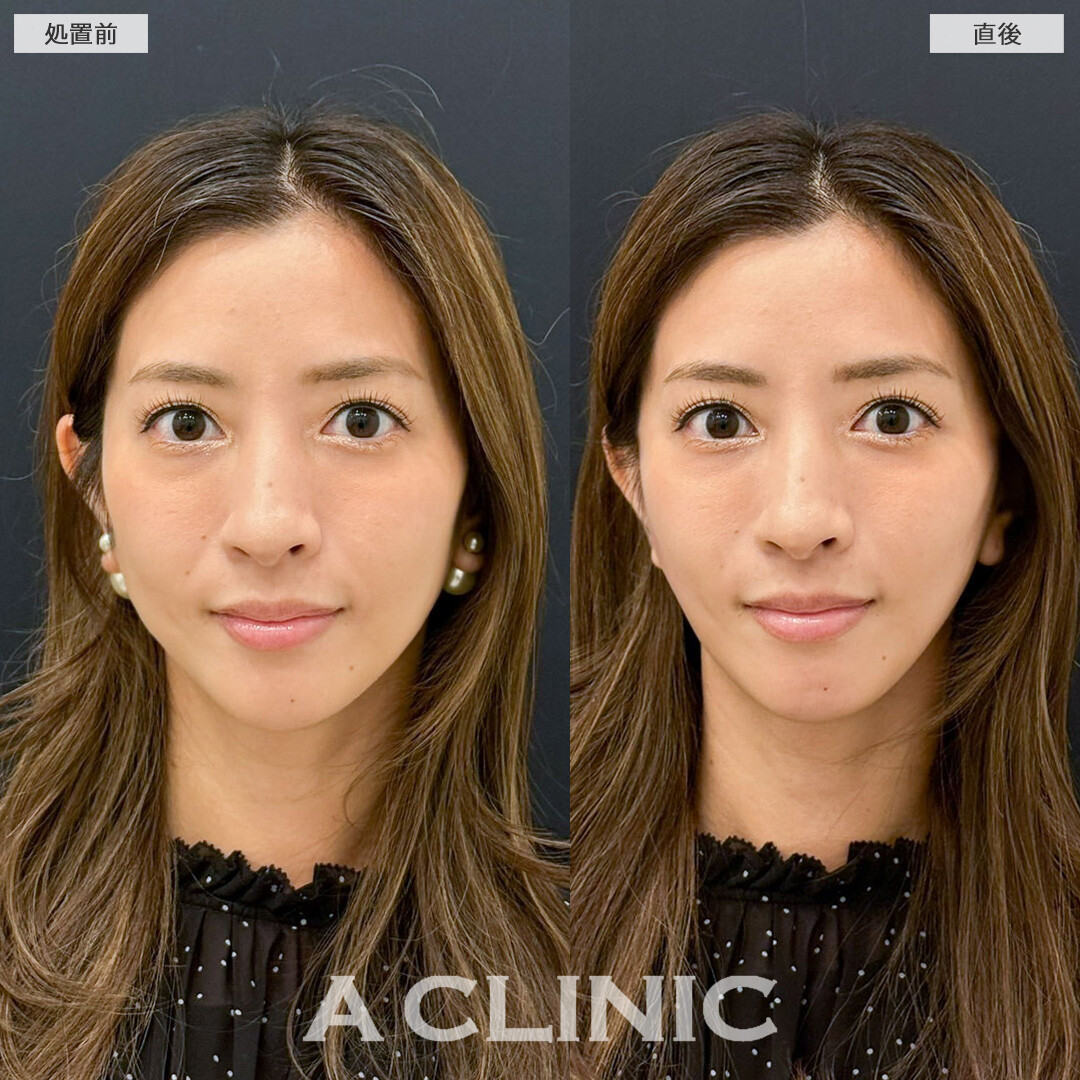 Aスレッドで口元のもたつき解消しナチュラルに小顔になりました！こちら処置前と直後の症例です(30代女性)