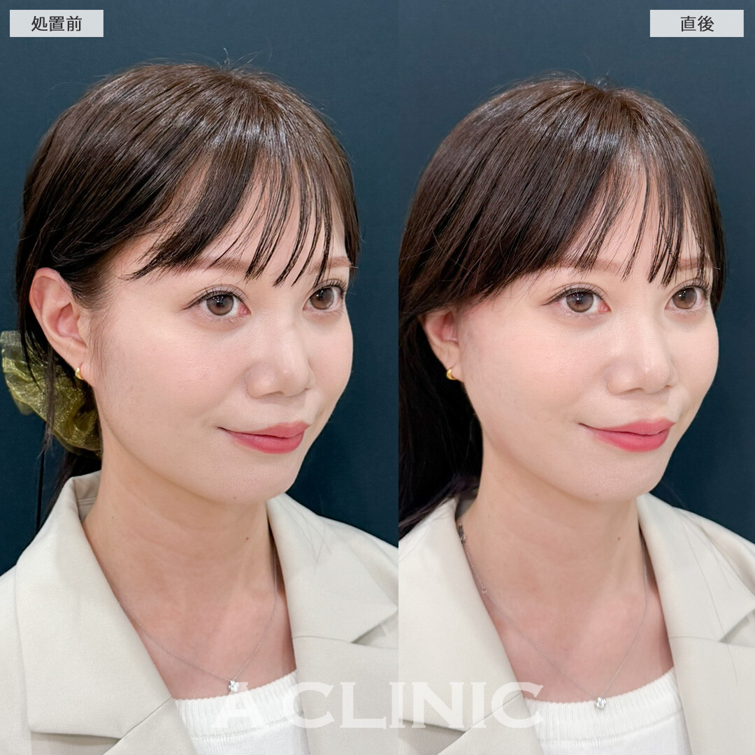 Aスレッドで口横のたるみとほうれい線を同時に改善！処置前と直後の症例です(30代女性)