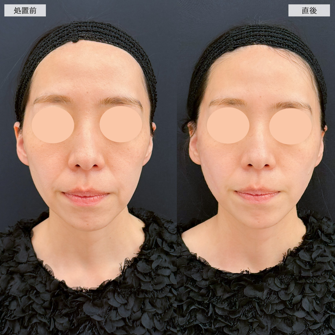 Aスレッドと頬へのヒアルロン酸注入で左右差無くなりほうれい線も薄くなりました！処置前と直後の症例です(30代女性)