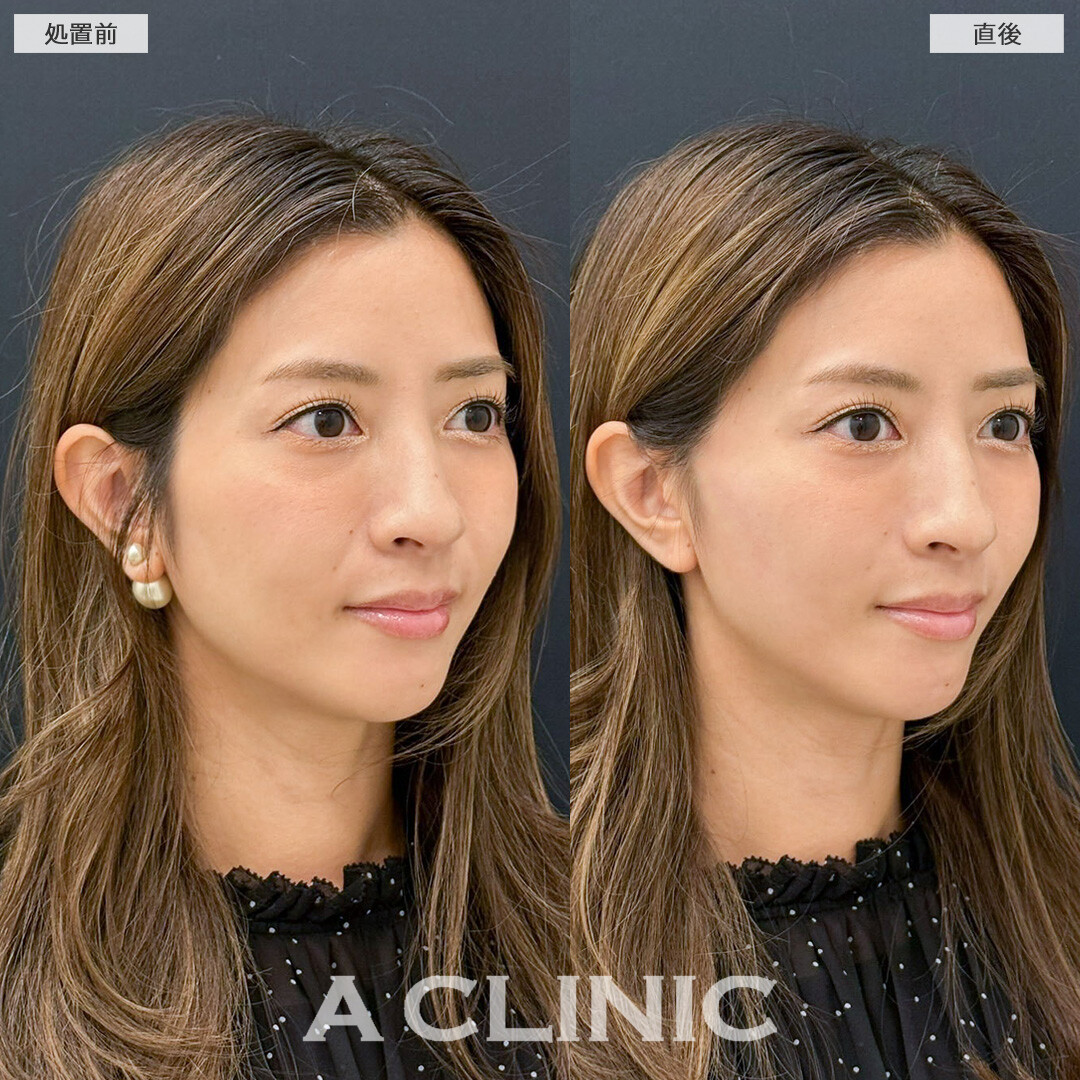 Aスレッドで口元のもたつき解消しナチュラルに小顔になりました！こちら処置前と直後の症例です(30代女性)