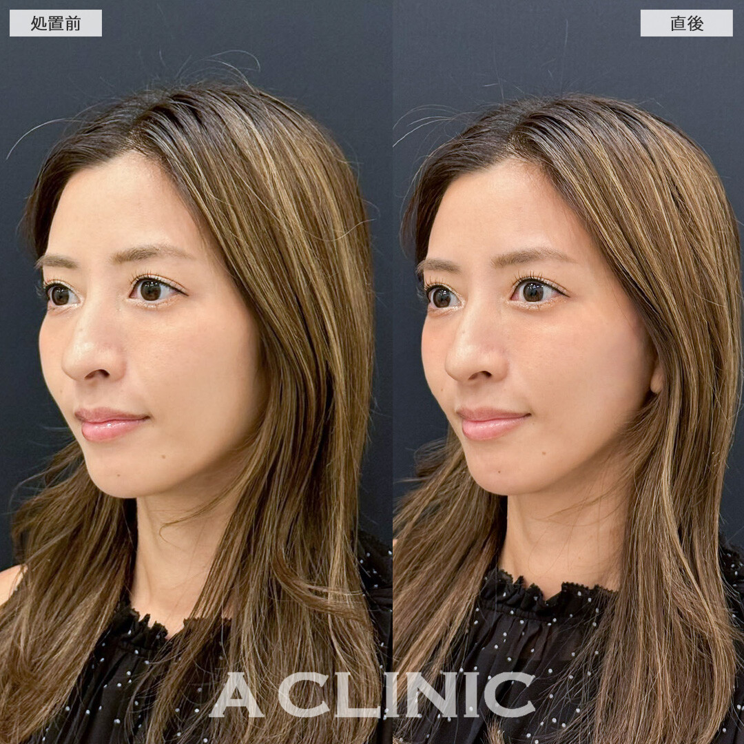 Aスレッドで口元のもたつき解消しナチュラルに小顔になりました！こちら処置前と直後の症例です(30代女性)