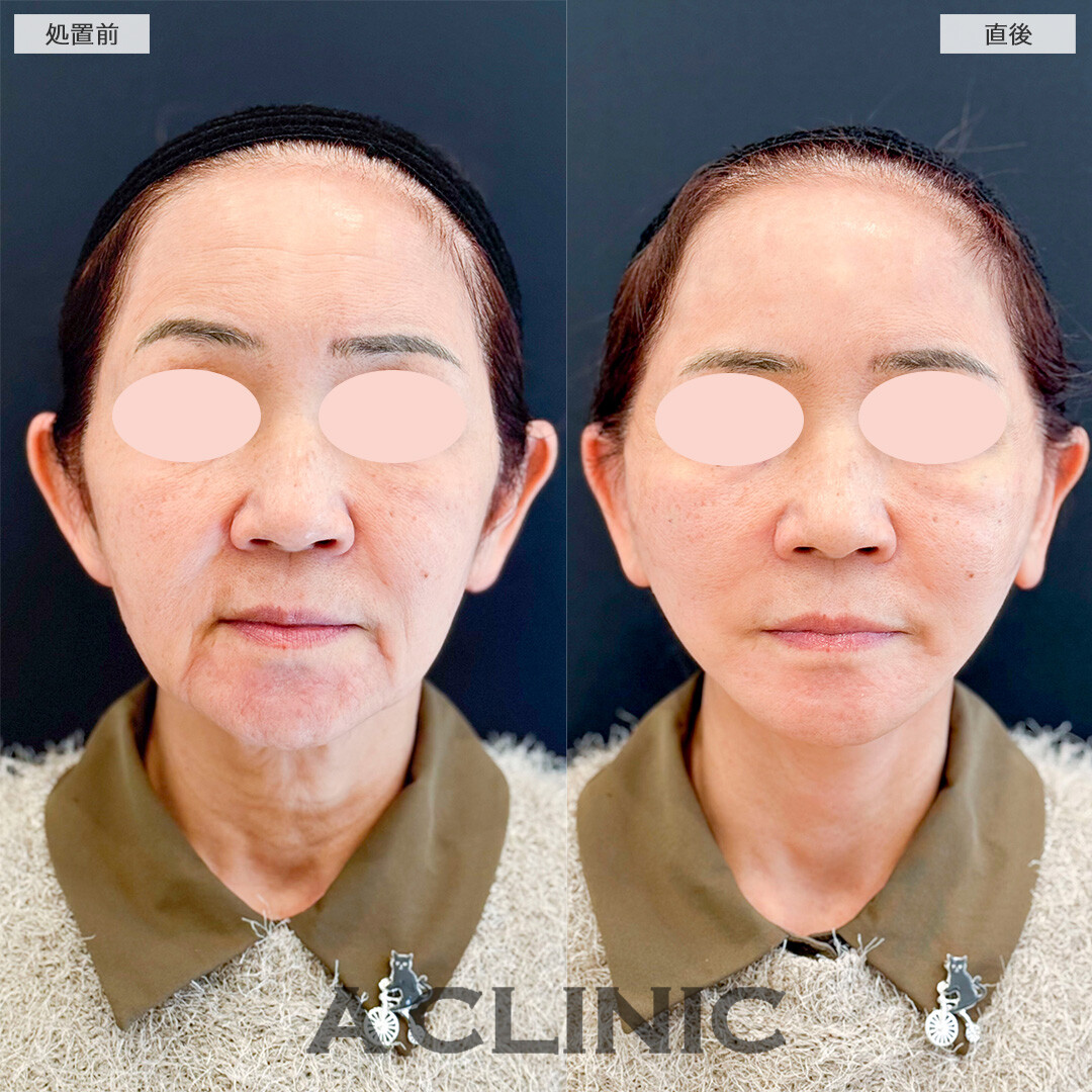 Aスレッドでたるみとマリオネットラインを同時に解消！処置前と直後の症例です(60代女性)