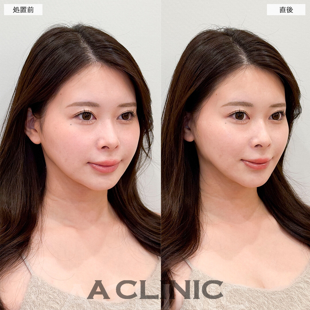 Aスレッドでたるみのない輪郭をキープ！処置前と直後の症例です(20代女性)