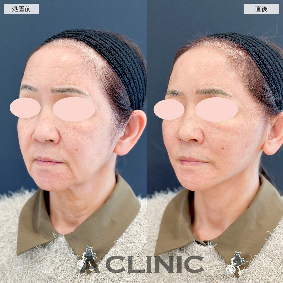 Aスレッドでたるみとマリオネットラインを同時に解消！処置前と直後の症例です(60代女性)