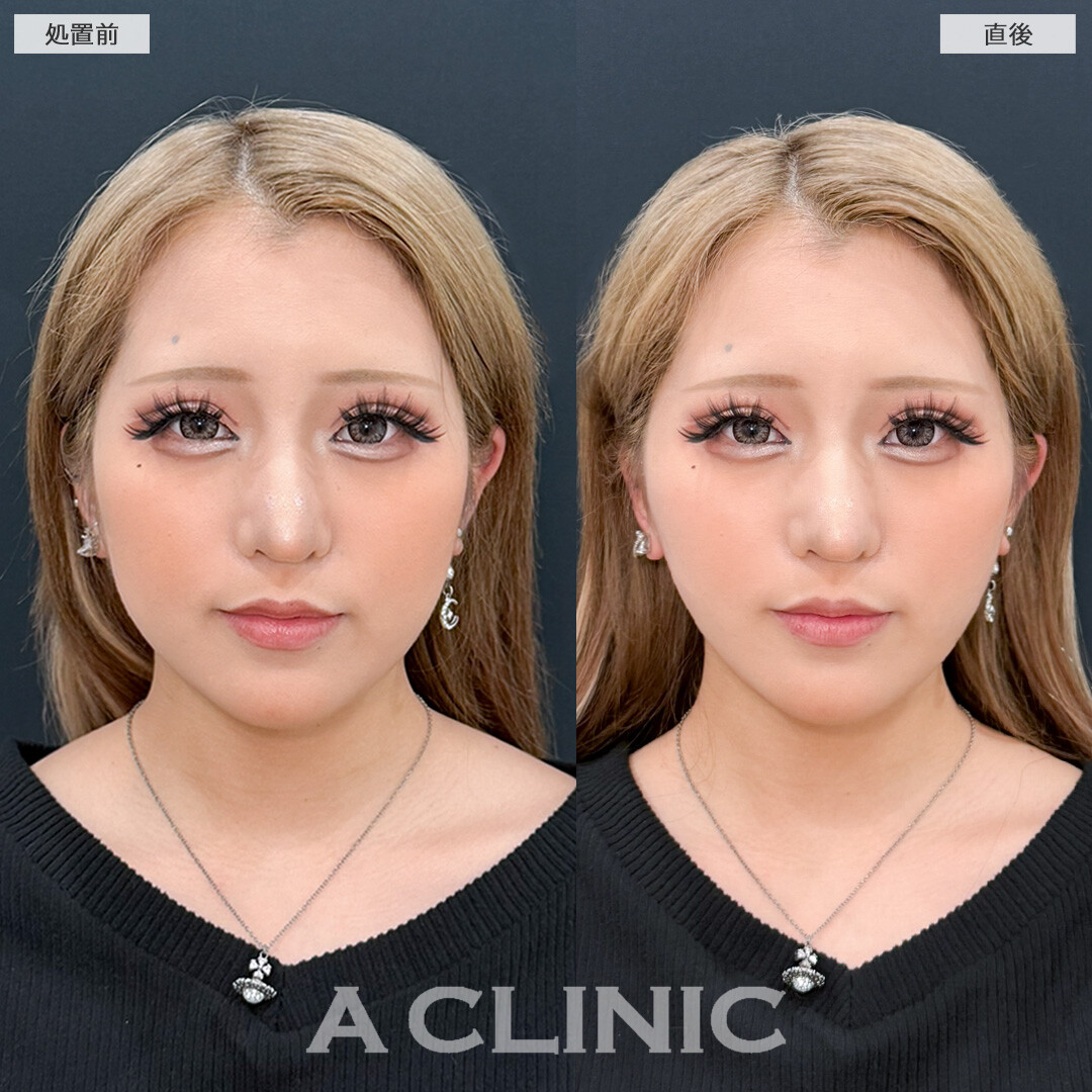 Aスレッドで口横がシャープになりVフェイスになれました！処置前と直後の症例です(10代女性)