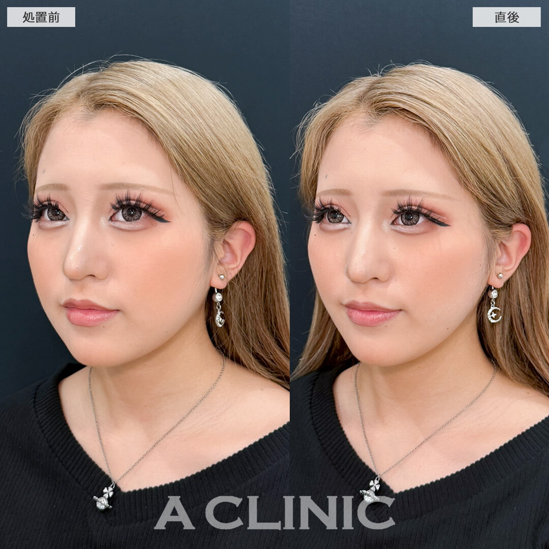 Aスレッドで口横がシャープになりVフェイスになれました！処置前と直後の症例です(10代女性)