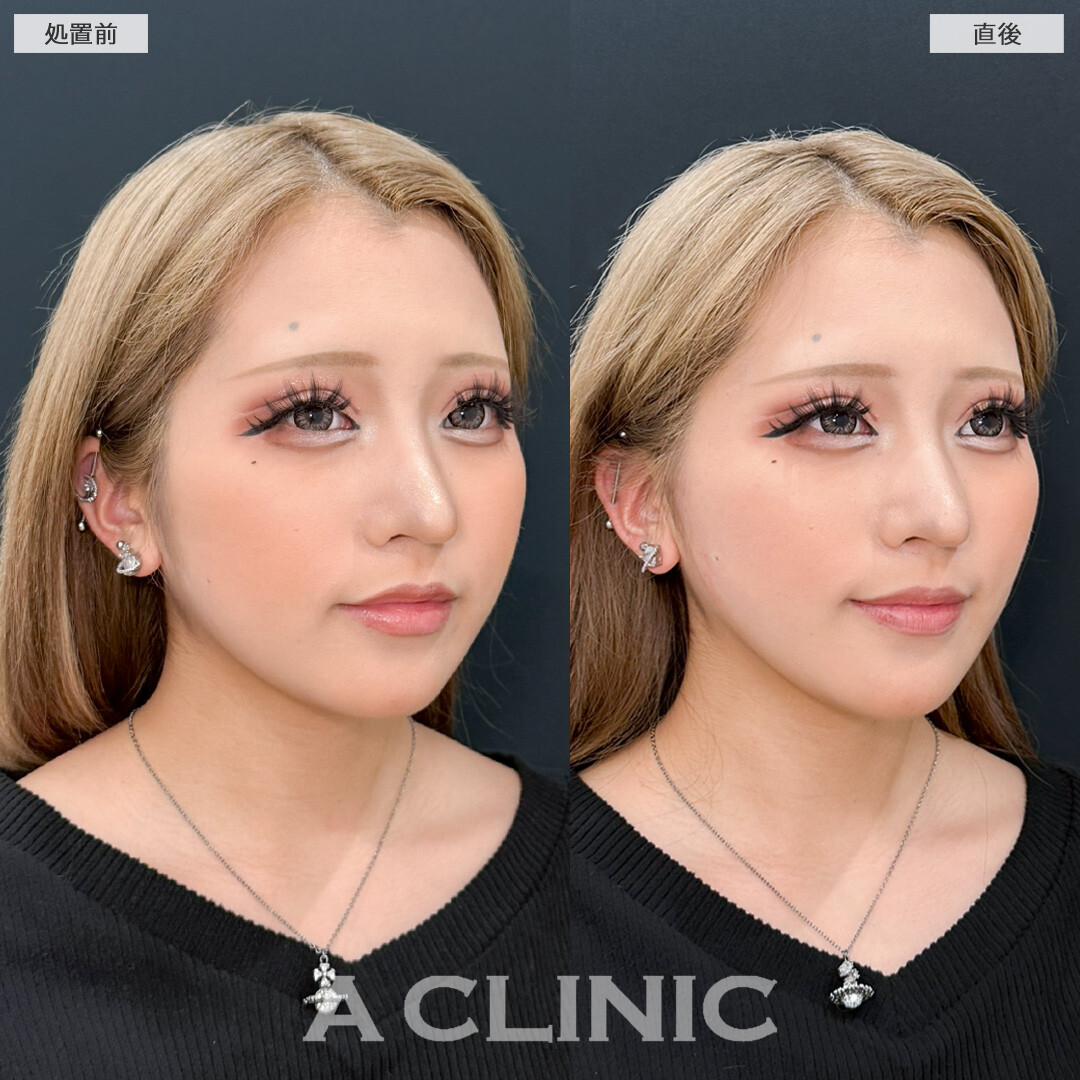 Aスレッドで口横がシャープになりVフェイスになれました！処置前と直後の症例です(10代女性)