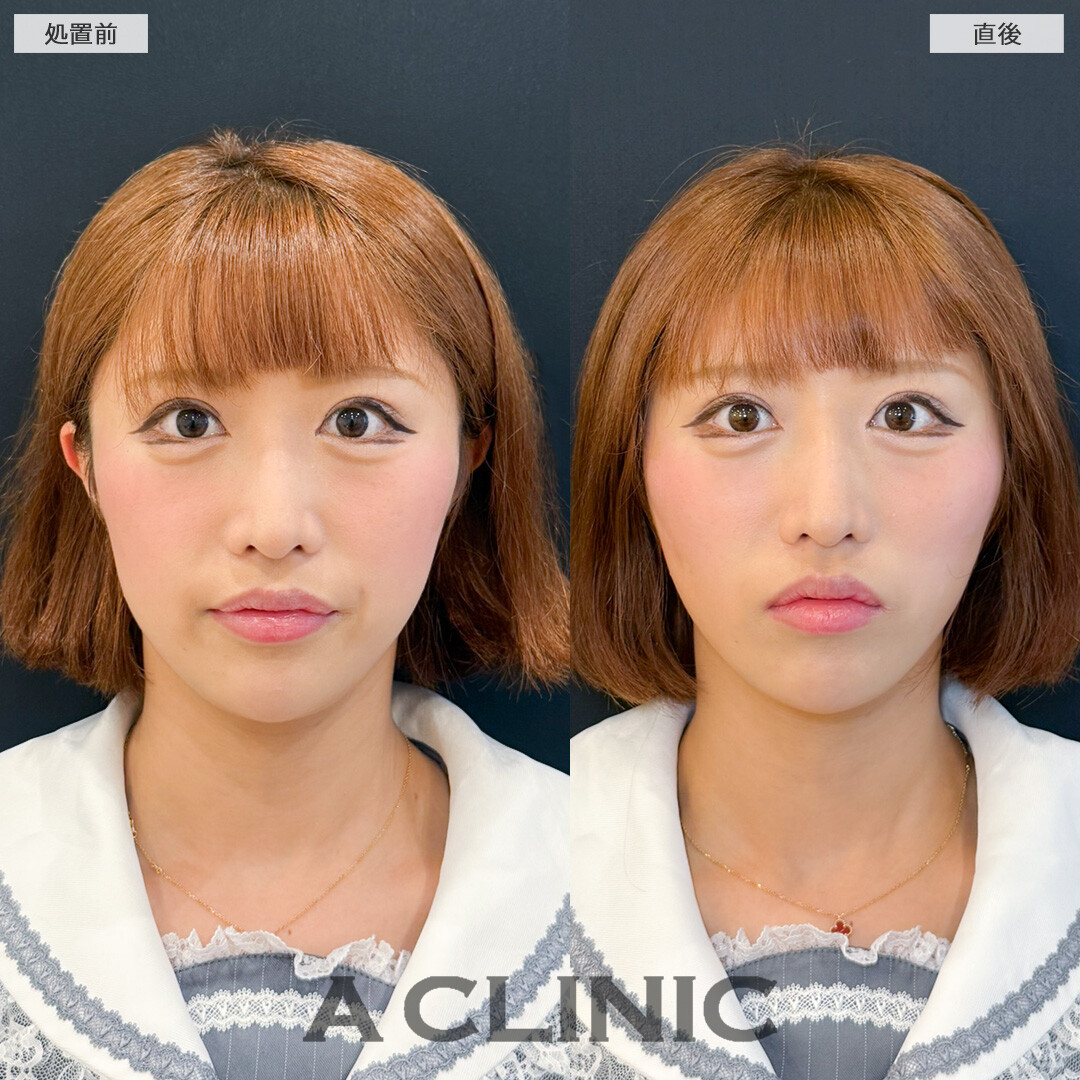 Aスレッドで口横の膨らみもスッキリ引き上げ！処置前と直後の症例です(20代女性)