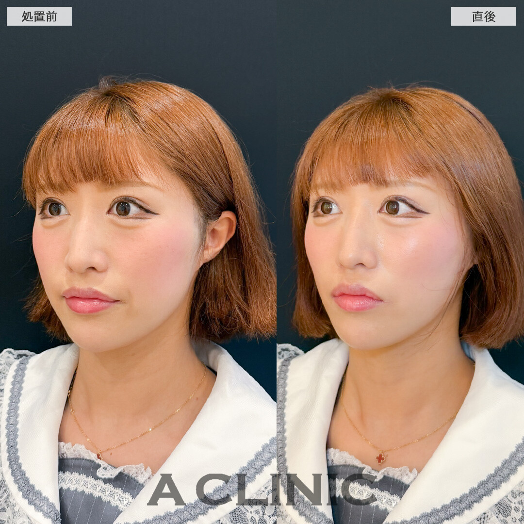 Aスレッドで口横の膨らみもスッキリ引き上げ！処置前と直後の症例です(20代女性)