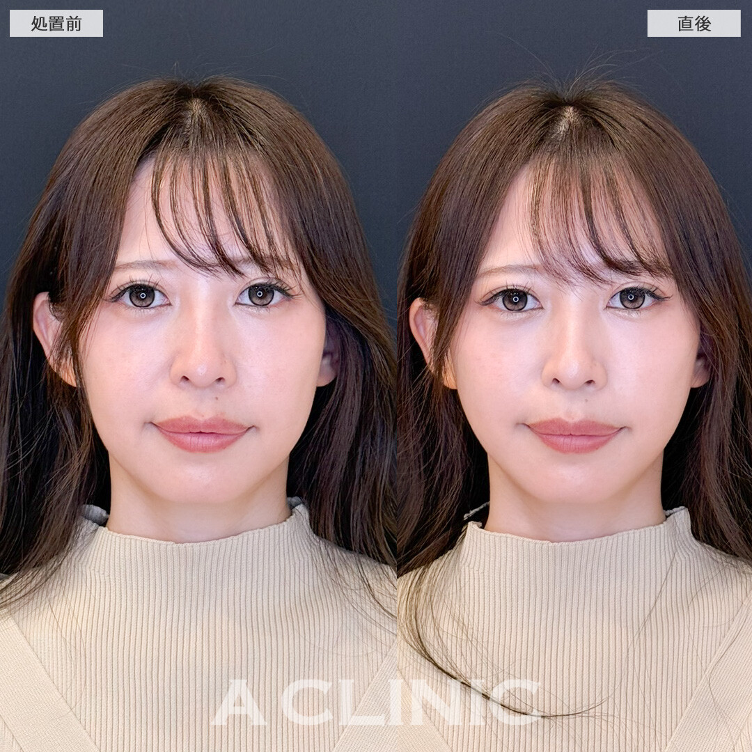 Aスレッドでフェイスラインや口横のもたつき改善しスッキリ若返り！処置前と直後の症例です(30代女性)