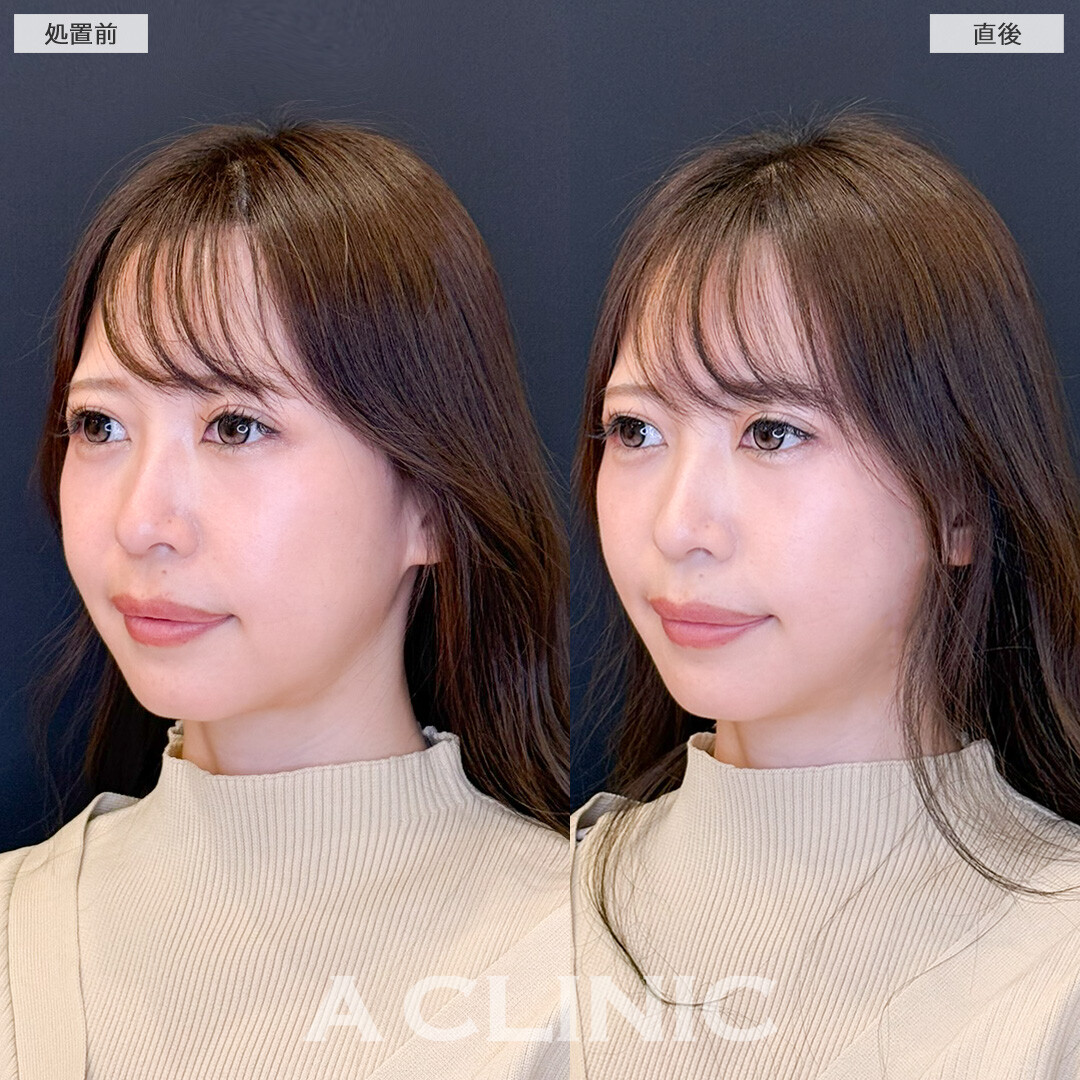Aスレッドでフェイスラインや口横のもたつき改善しスッキリ若返り！処置前と直後の症例です(30代女性)