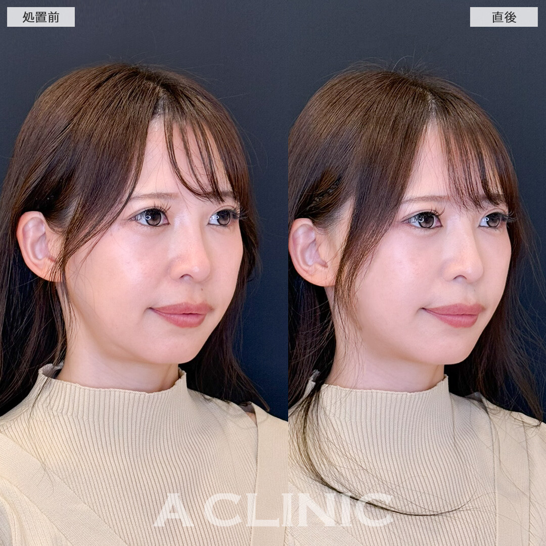 Aスレッドでフェイスラインや口横のもたつき改善しスッキリ若返り！処置前と直後の症例です(30代女性)