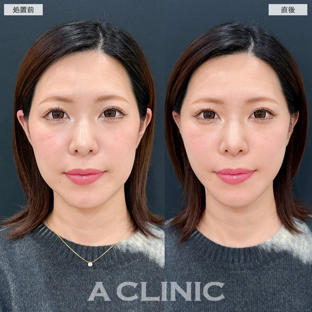 Aスレッドでフェイスライン引き上げてたるみ解消できました！処置前と直後の症例です(30代女性)