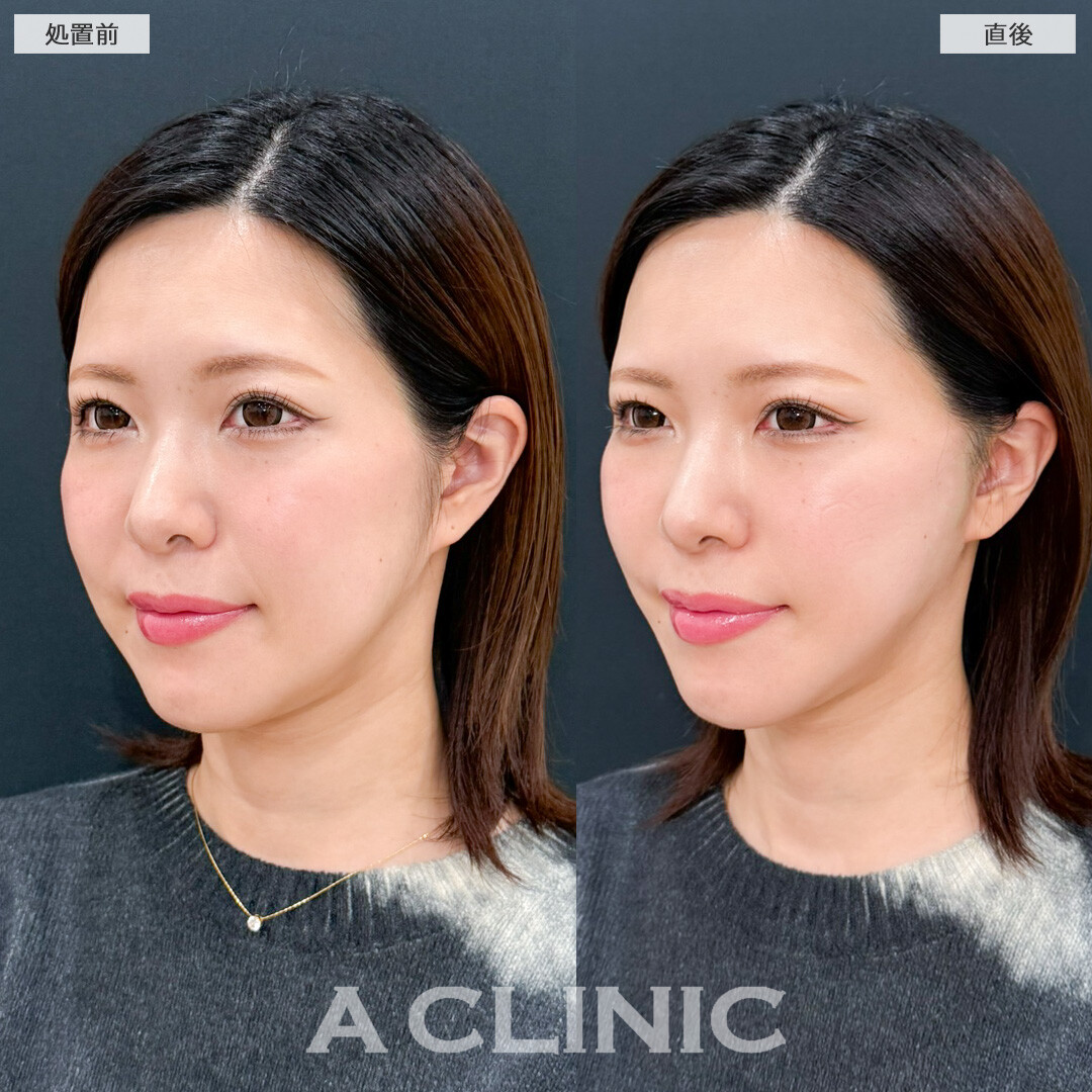 Aスレッドでフェイスライン引き上げてたるみ解消できました！処置前と直後の症例です(30代女性)