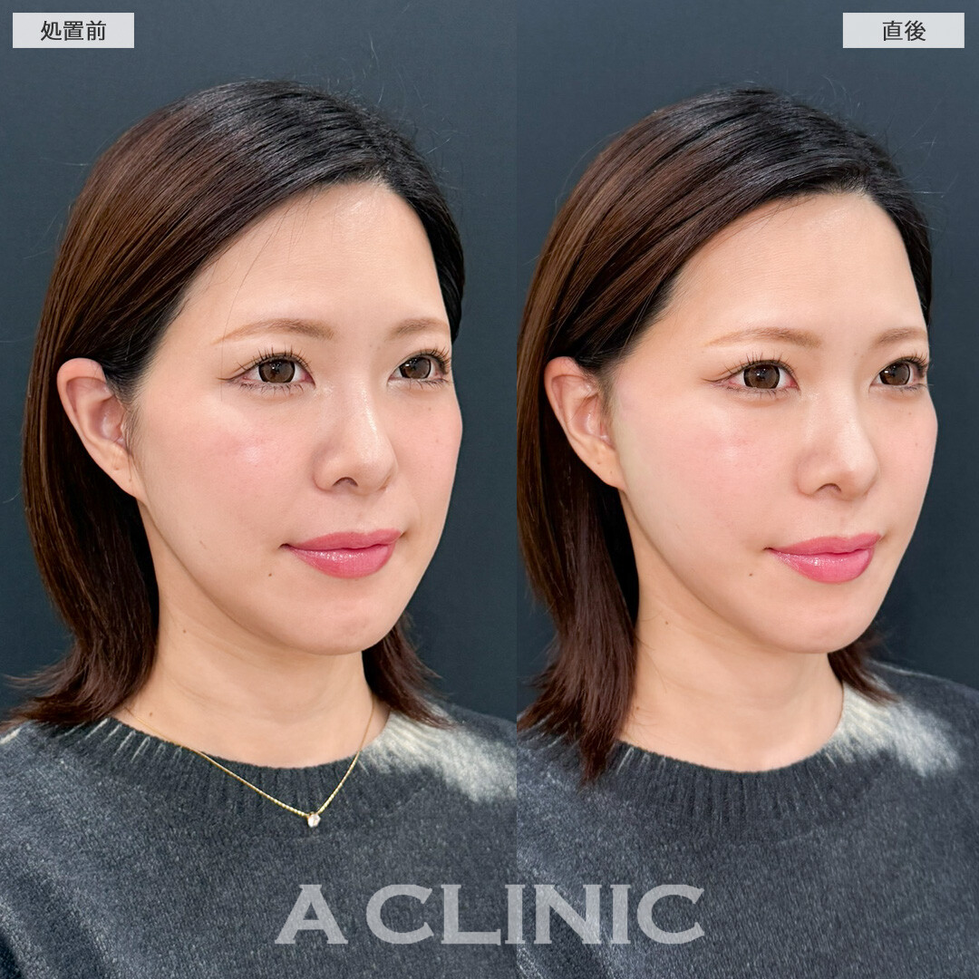 Aスレッドでフェイスライン引き上げてたるみ解消できました！処置前と直後の症例です(30代女性)