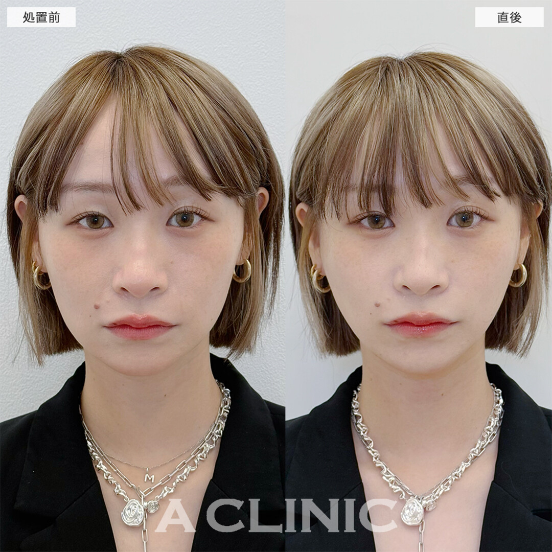 Aスレッドで左右対称の輪郭になりました！こちら処置前と直後の症例です(20代女性)