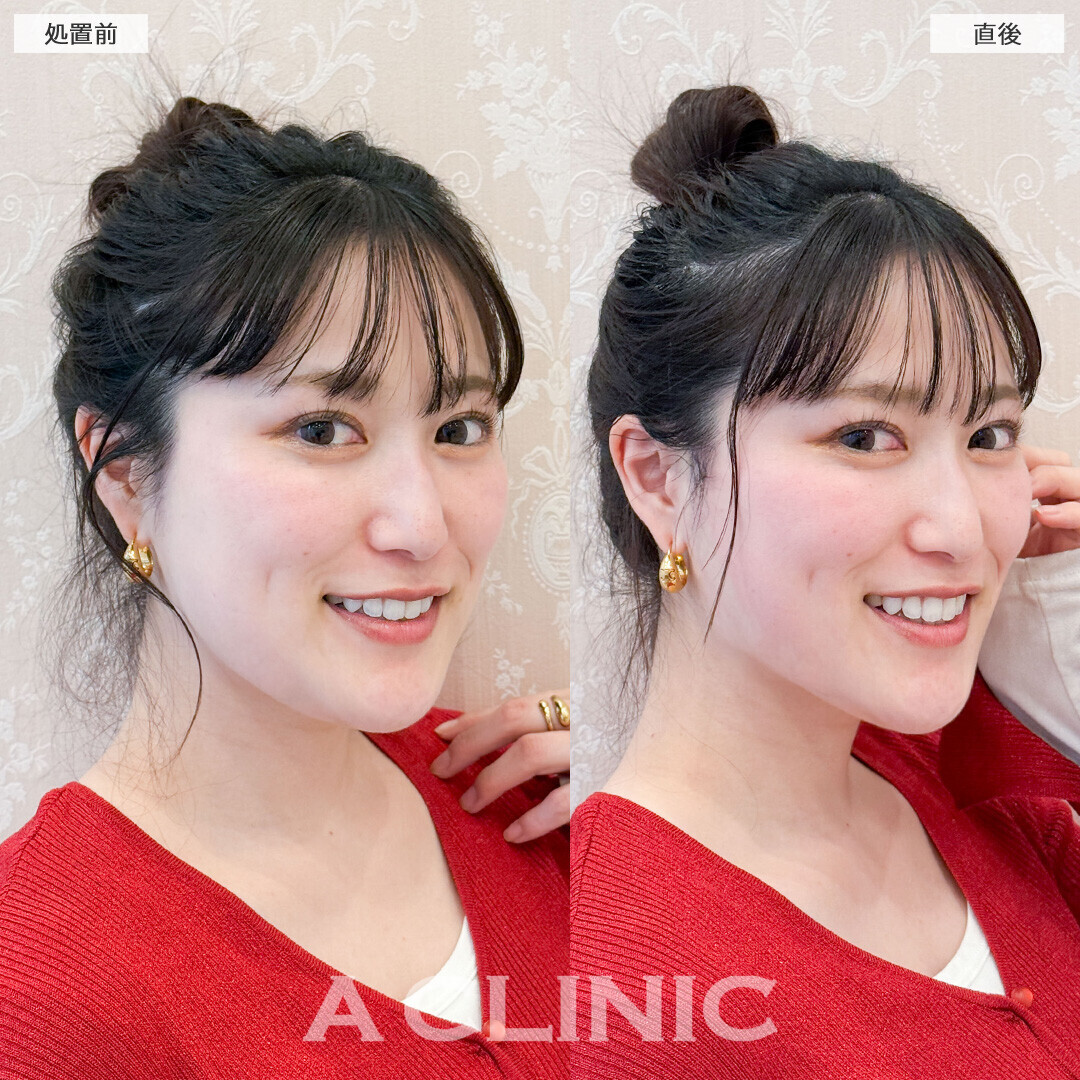 Aスレッドで他撮りでも盛れる輪郭になりました！こちら処置前と直後の症例です(30代女性)