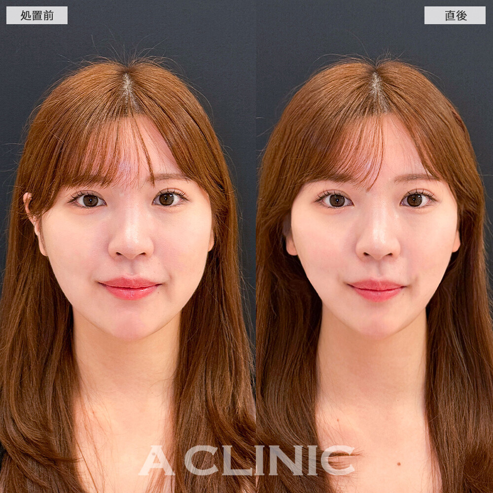 Aスレッドで余白のない理想的なVフェイスに！こちら処置前と直後の症例です(20代女性)