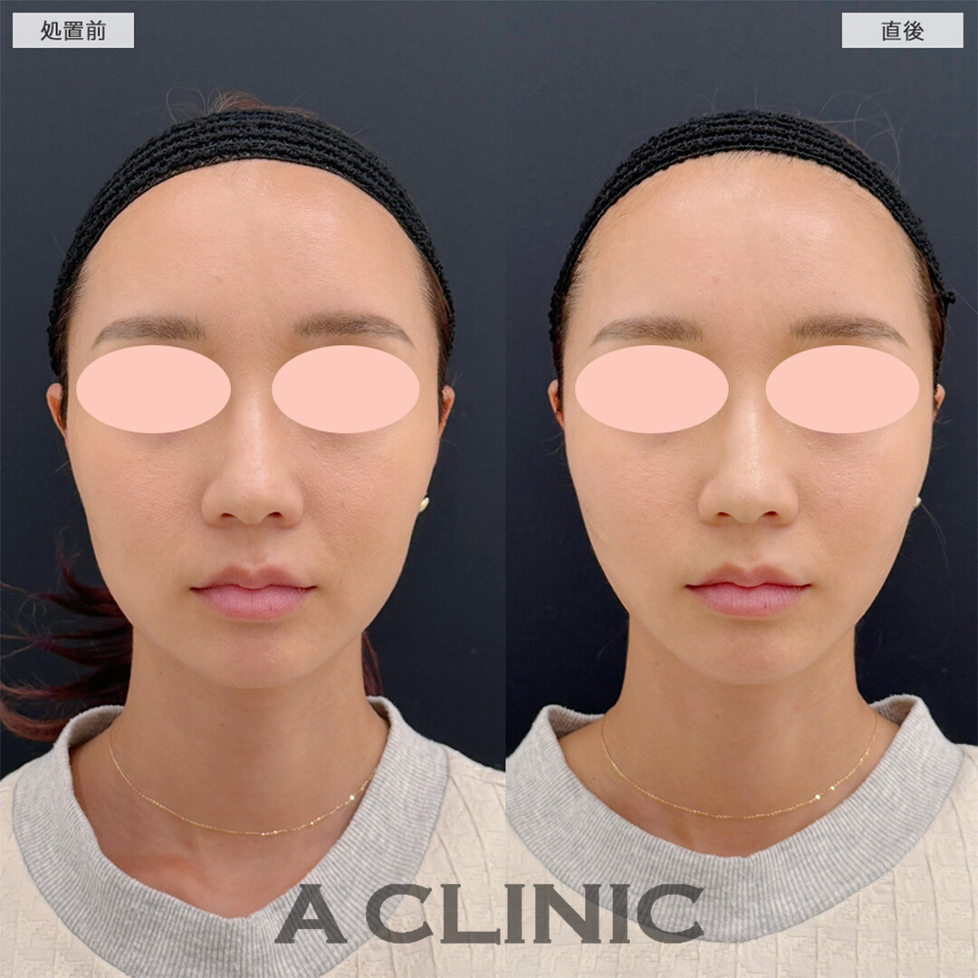 Aスレッドは左右対称な輪郭にもなれます！こちら処置前と直後の症例です(30代女性)
