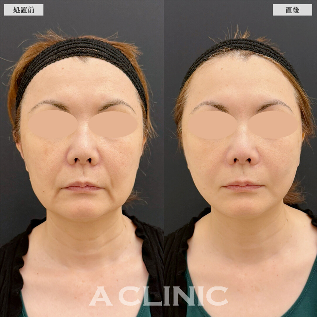 Aスレッドは蓄積されたたるみもたった15分で引き上がります！こちら処置前と直後の症例です(50代女性)