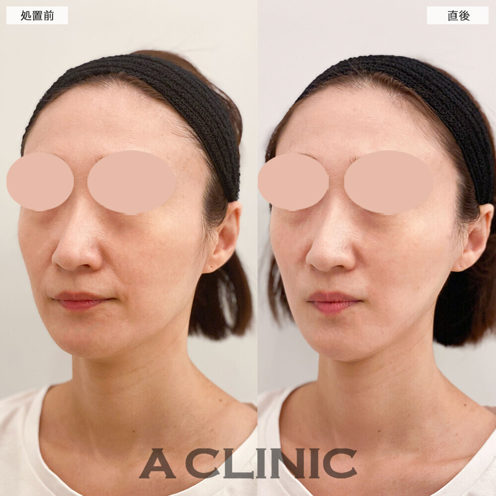 Aスレッドでほうれい線も改善されスッキリとした輪郭に！こちら処置前と直後の症例です(40代女性)