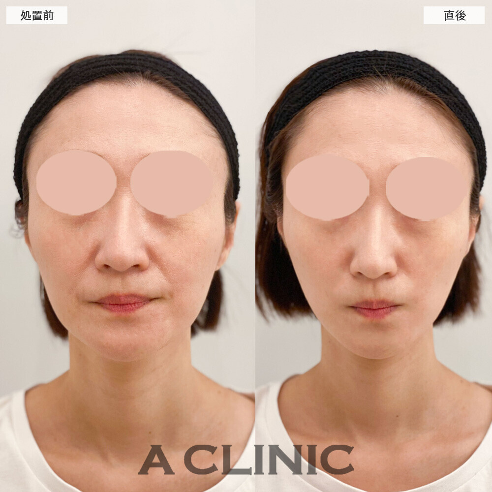 Aスレッドでほうれい線も改善されスッキリとした輪郭に！こちら処置前と直後の症例です(40代女性)