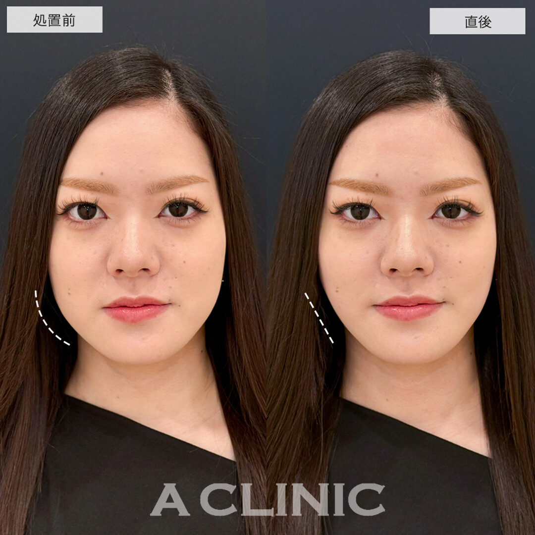 Aスレッドで輪郭の左右差が改善し爆美女に大変身!こちら処置前と直後の症例です(20代女性)