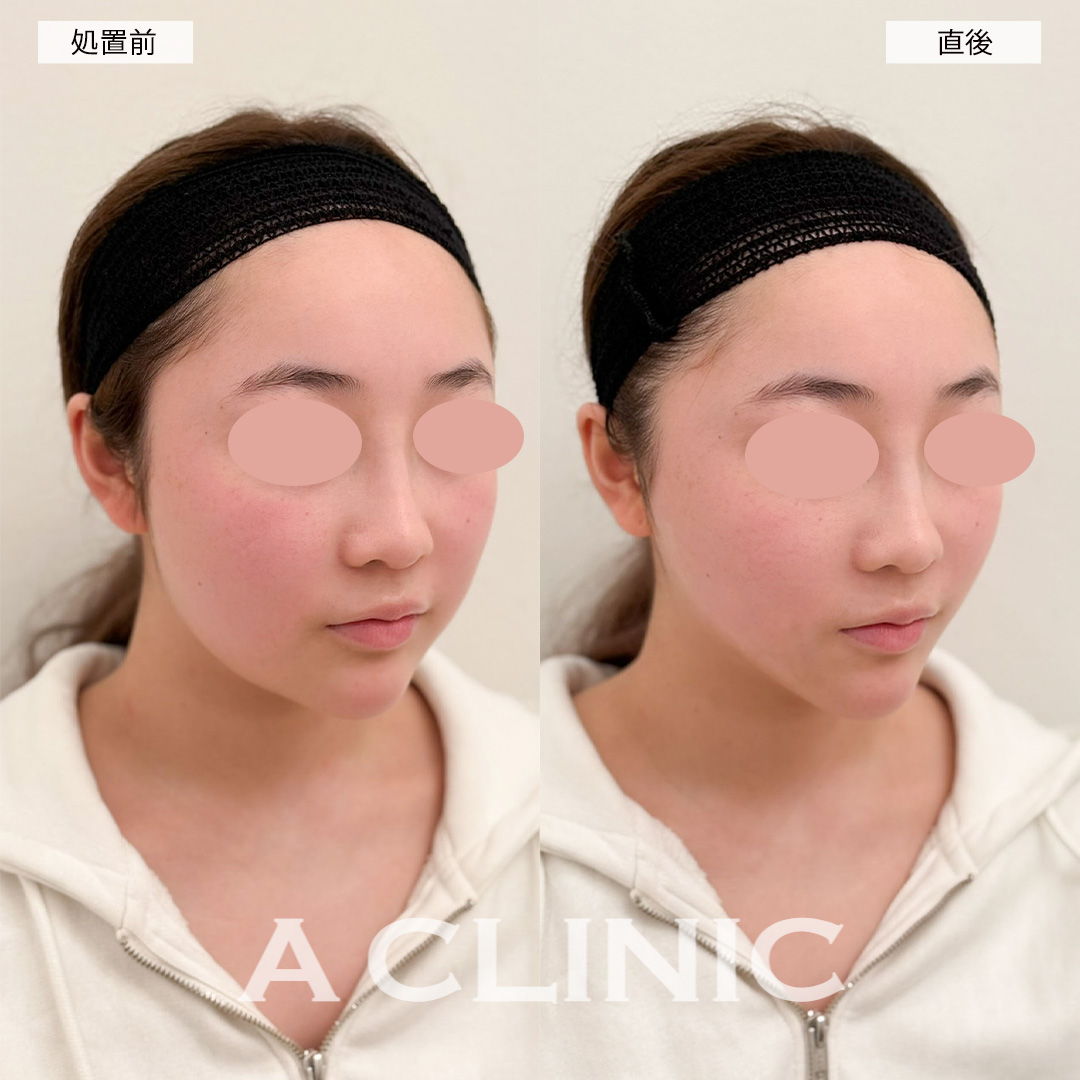 Aスレッドで直後からリフトアップし垢抜け成功!こちら処置前と直後の症例です(10代女性)