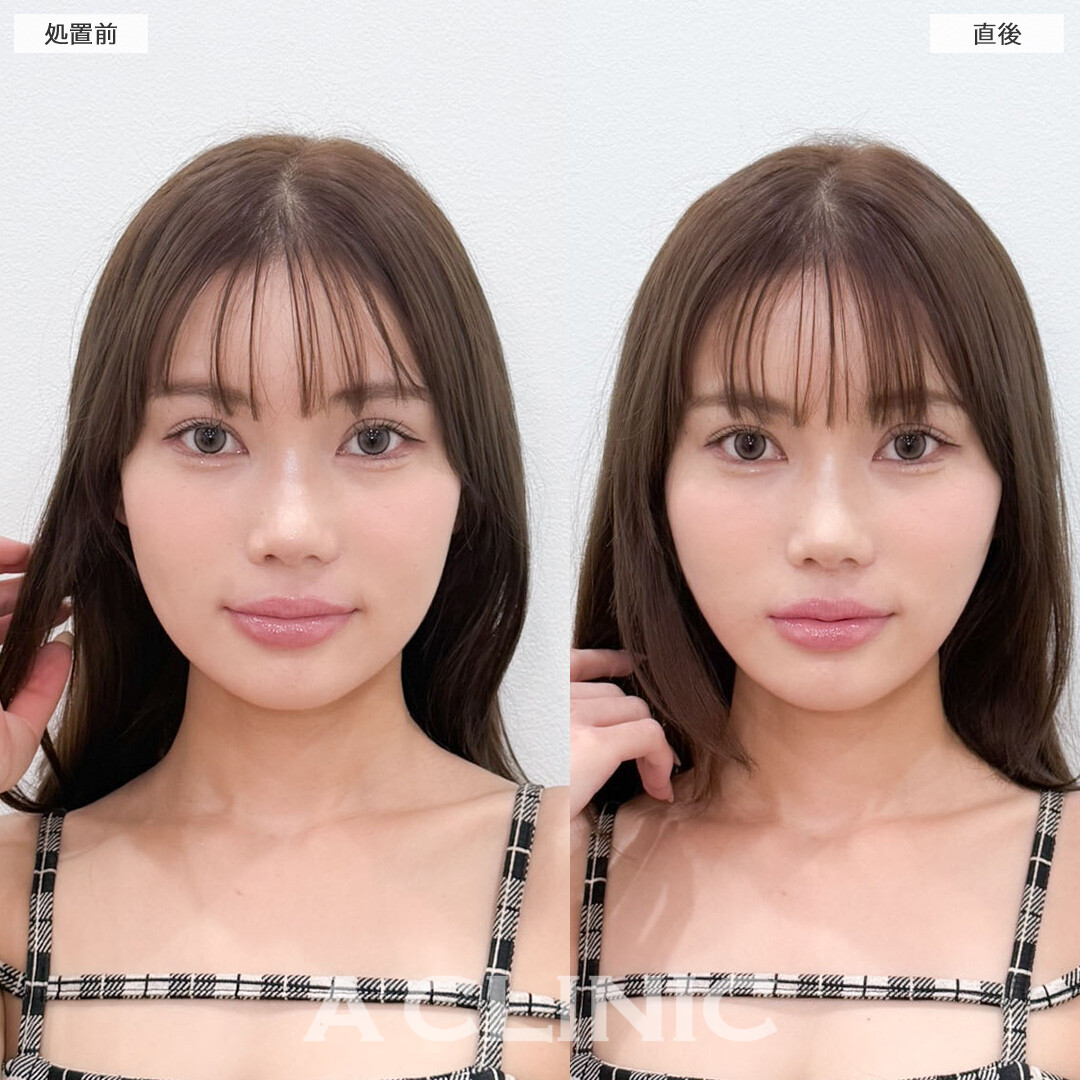 Aスレッドと小顔エラボトックスでもたつきも気にならなくなります！こちら処置前と直後の症例です(20代女性)