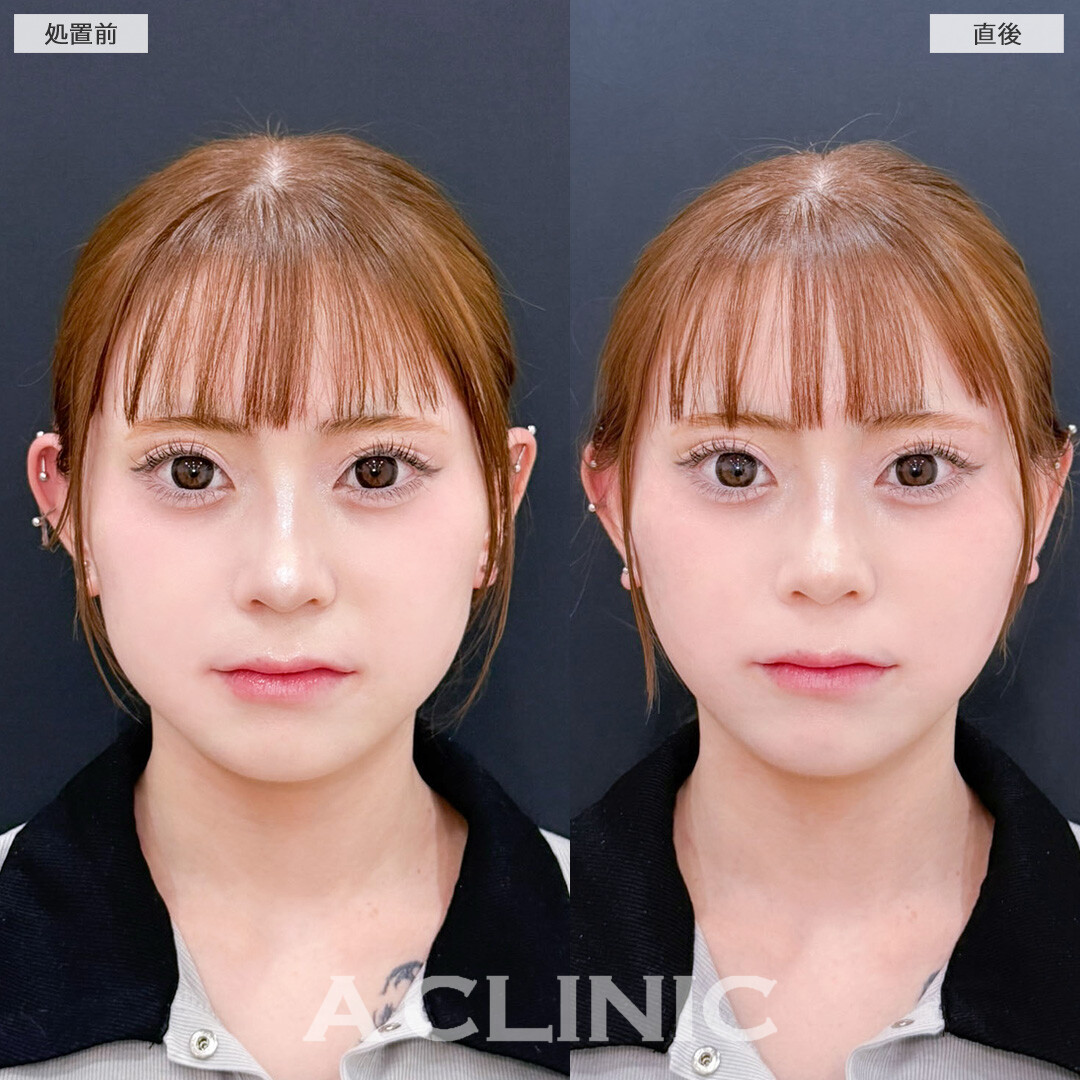 Aスレッドで自然にたまご型フェイスに！こちら処置前と直後の症例です(20代女性)