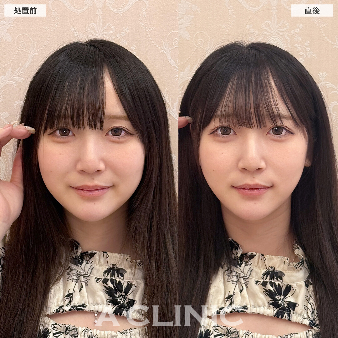 Aスレッドで左右差がなくなりスッキリした印象に！こちら処置前と直後の症例です(20代女性)