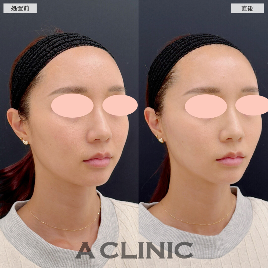 Aスレッドは左右対称な輪郭にもなれます！こちら処置前と直後の症例です(30代女性)