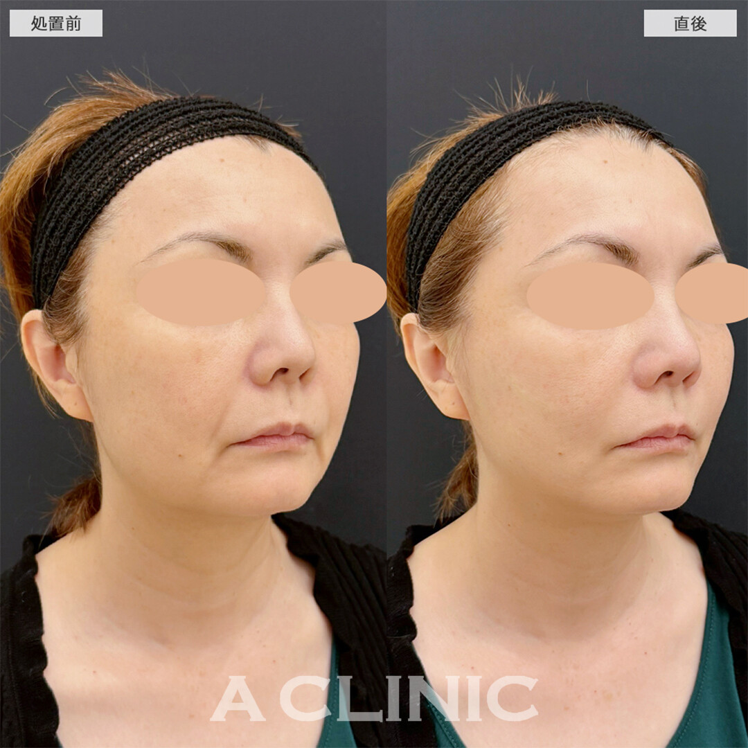 Aスレッドは蓄積されたたるみもたった15分で引き上がります！こちら処置前と直後の症例です(50代女性)
