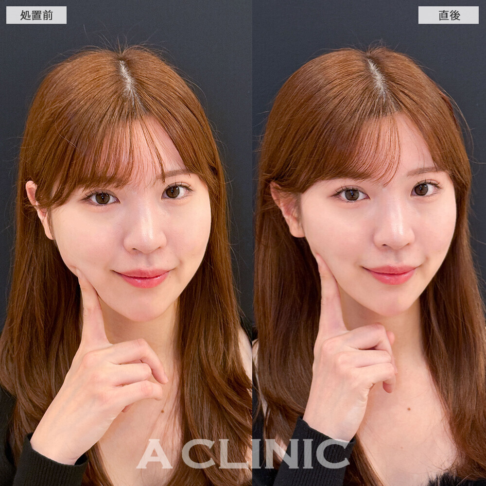 Aスレッドで余白のない理想的なVフェイスに！こちら処置前と直後の症例です(20代女性)