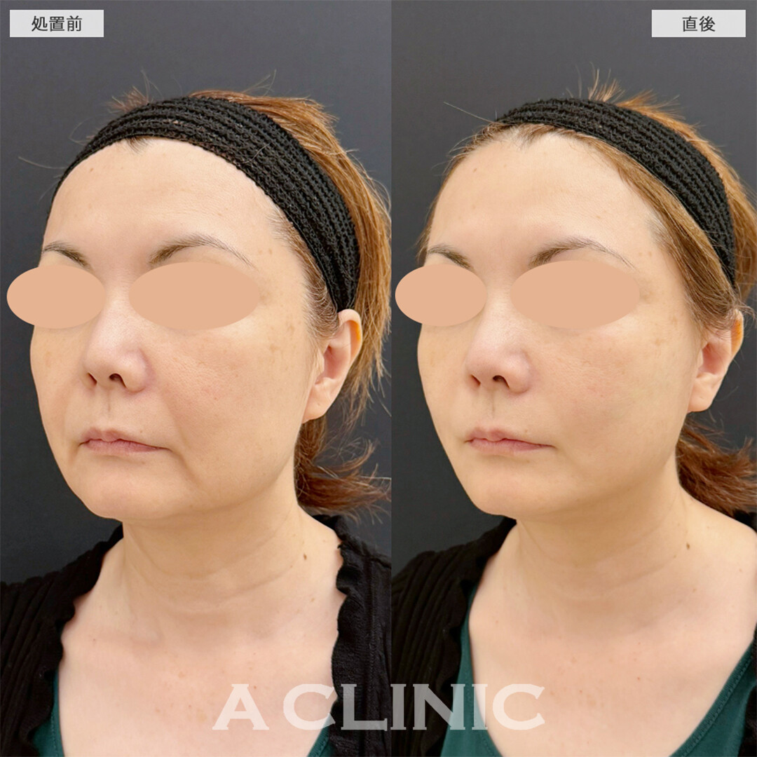 Aスレッドは蓄積されたたるみもたった15分で引き上がります！こちら処置前と直後の症例です(50代女性)