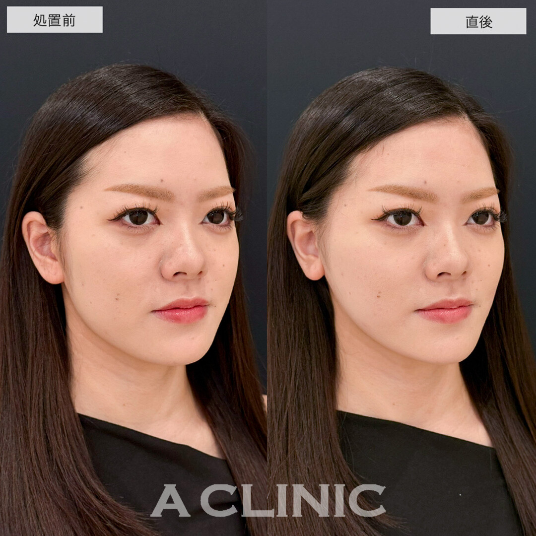 Aスレッドで輪郭の左右差が改善し爆美女に大変身!こちら処置前と直後の症例です(20代女性)