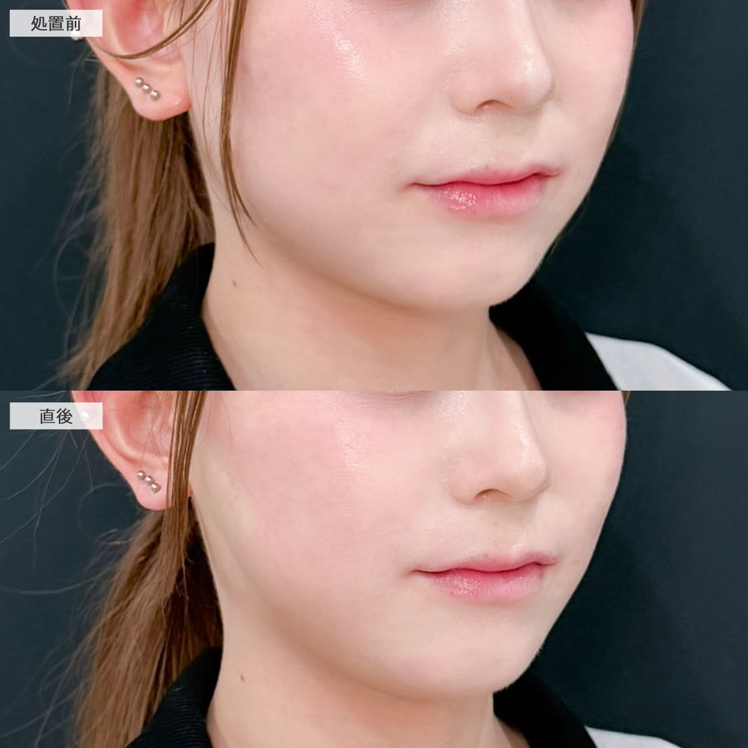 Aスレッドで自然にたまご型フェイスに！こちら処置前と直後の症例です(20代女性)