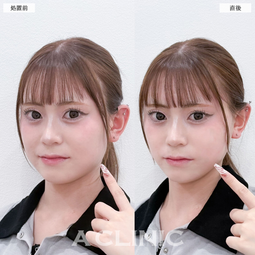 Aスレッドで自然にたまご型フェイスに！こちら処置前と直後の症例です(20代女性)