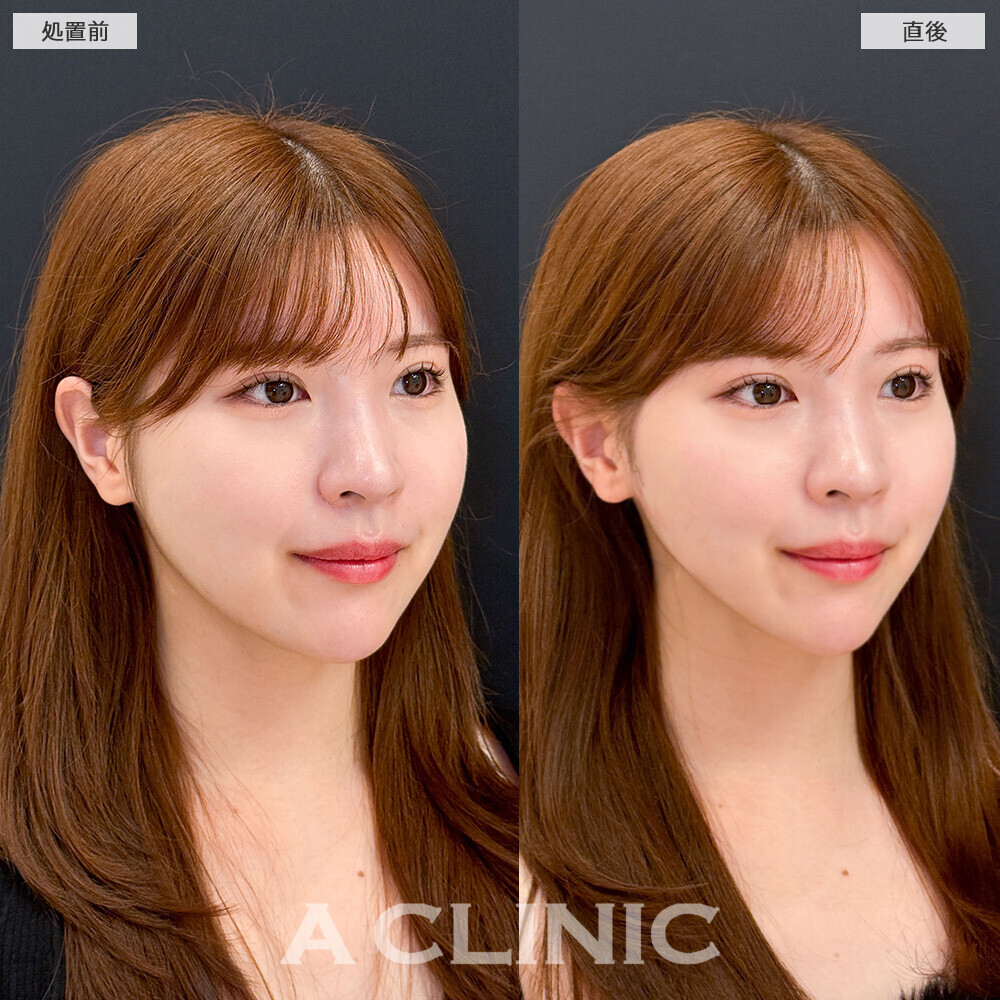 Aスレッドで余白のない理想的なVフェイスに！こちら処置前と直後の症例です(20代女性)