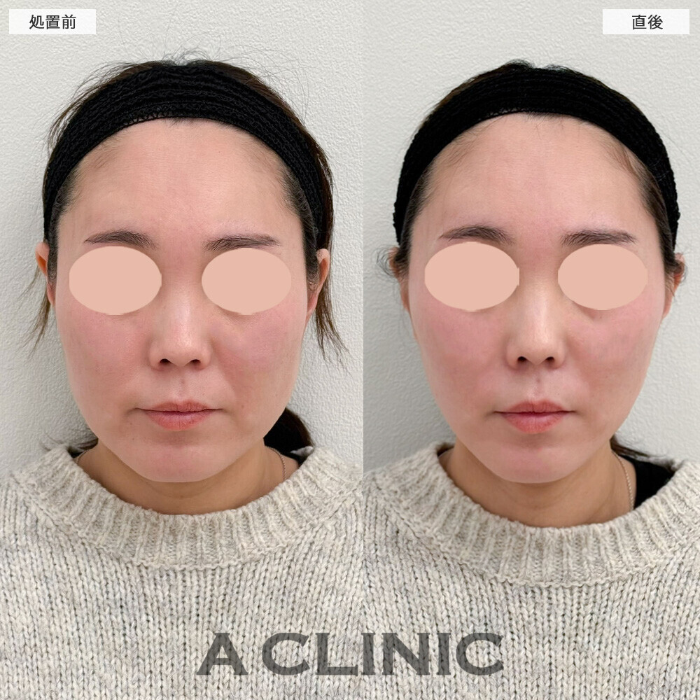 Aスレッドとヒアルロン酸注射(シワ)で四角い輪郭が卵型の輪郭に！こちら処置前と直後の症例です(30代女性)