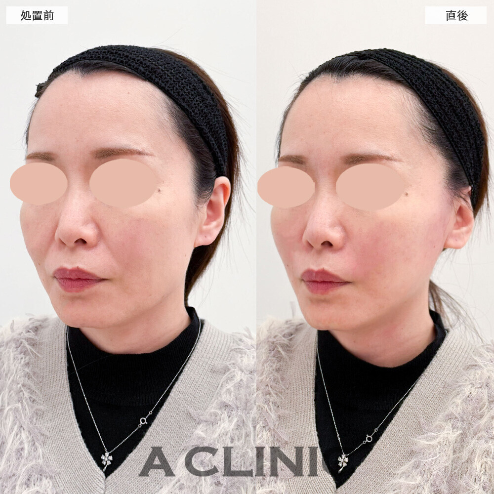 Aスレッドとヒアルロン酸注射(シワ)でほうれい線が改善され10歳若返りました！こちら処置前と直後の症例です(40代女性)