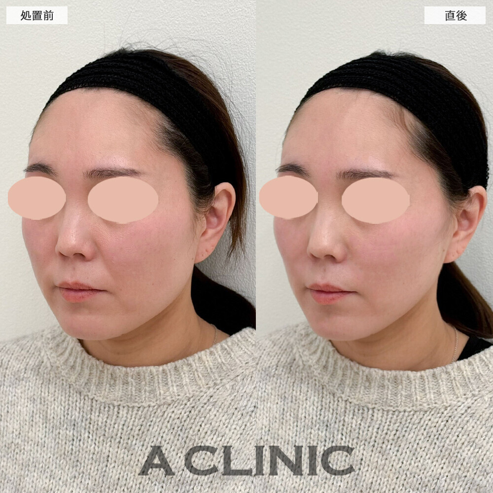 Aスレッドとヒアルロン酸注射(シワ)で四角い輪郭が卵型の輪郭に！こちら処置前と直後の症例です(30代女性)