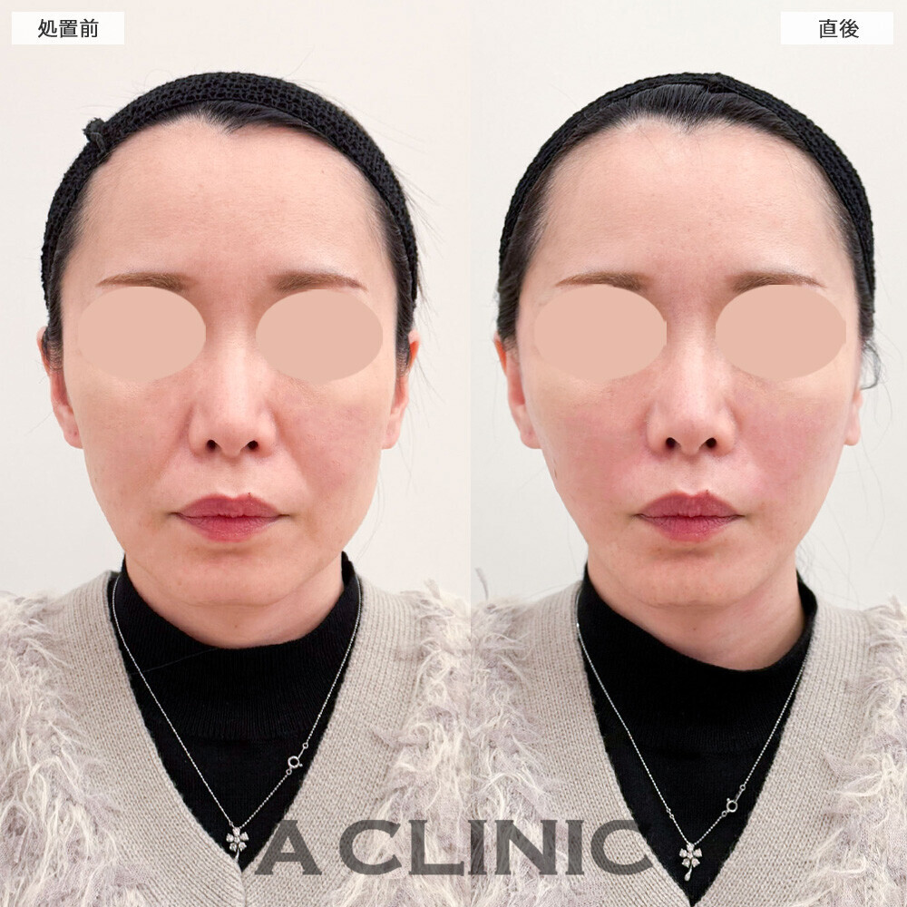 Aスレッドとヒアルロン酸注射(シワ)でほうれい線が改善され10歳若返りました！こちら処置前と直後の症例です(40代女性)